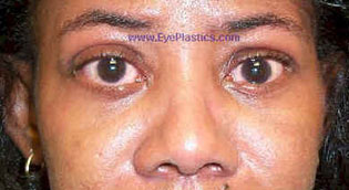 Upper Eyelid Retraction I ost - Operative - 2 weeks after lowering upper eyelids