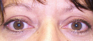 Pre and Post Operative Photograph: Thyroid Surgery