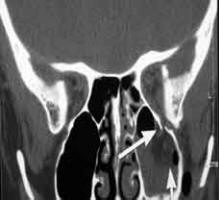 Image showing orbital trauma