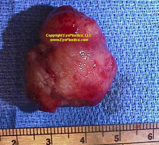 Image of an orbital hemangiopericytoma showing detailed tissue structure.