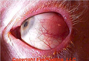 Image of orbital lymphoma