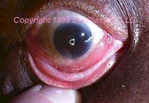 Image depicting a lymphoma tumor.