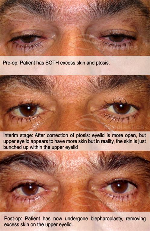 Before and after images of a patient who underwent ptosis and blepharoplasty surgery.