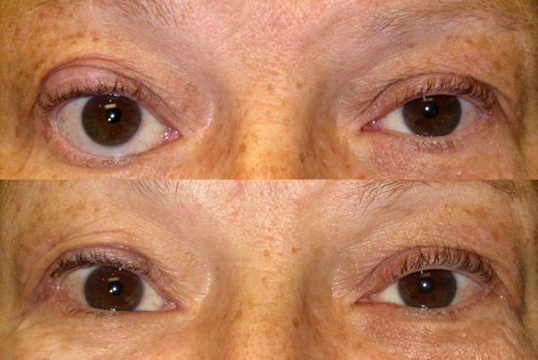 Cosmetic eyelid surgery, oculofacial Oculo-facial) surgeon locate Cosmetic eyelid surgery, oculofacial Oculo-facial) surgeon locate