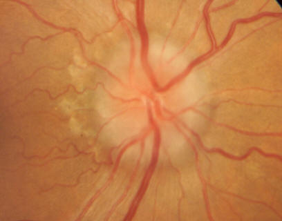 Image showing optic disc edema