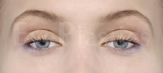 Photograph showing a person with bilateral ptosis, drooping eyelids affecting both eyes.