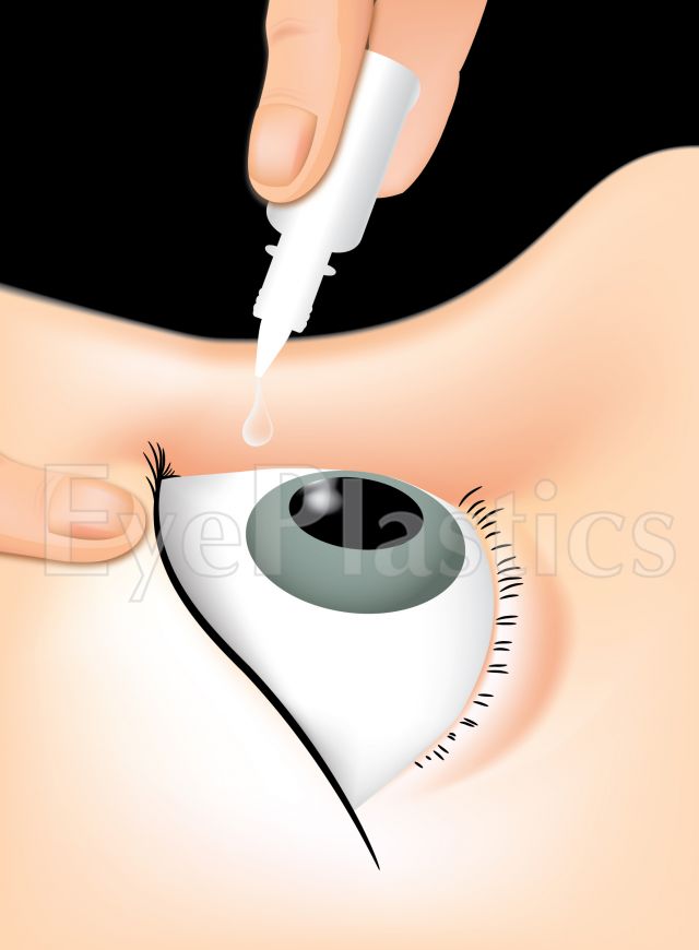 Image of eye drop bottle with text 'Neo' on the label.