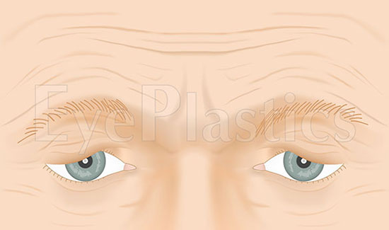Image showing normal eyebrow position