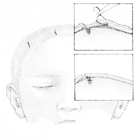 Endoscopic Eyebrow Lift 