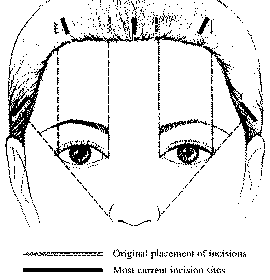 Endoscopic Eyebrow Lift 