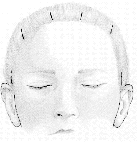 Endoscopic Eyebrow Lift 