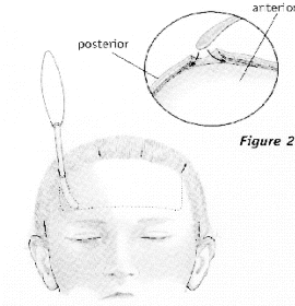 Endoscopic Eyebrow Lift 