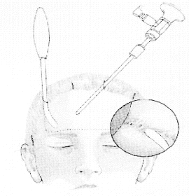 Endoscopic Eyebrow Lift 