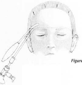 Endoscopic Eyebrow Lift 