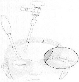 Endoscopic Eyebrow Lift 