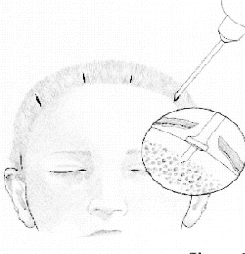 Endoscopic Eyebrow Lift 
