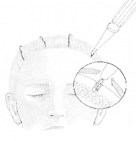 Endoscopic Eyebrow Lift 