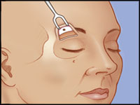 A diagram illustrating the in-direct brow lift procedure. The image shows the surgical technique with labels indicating the incision points and the direction of tissue elevation.