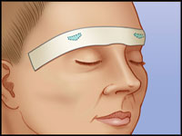 Illustration of a transbleph brow lift procedure showing surgical incisions and techniques for brow elevation.