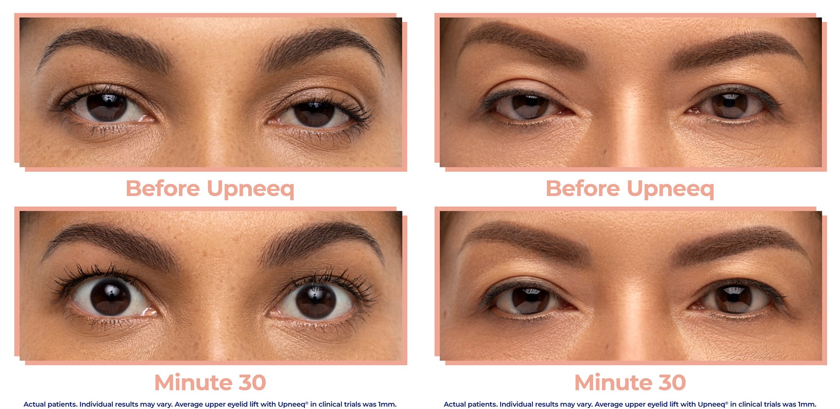 Two patients wearing Upneeq eye drops