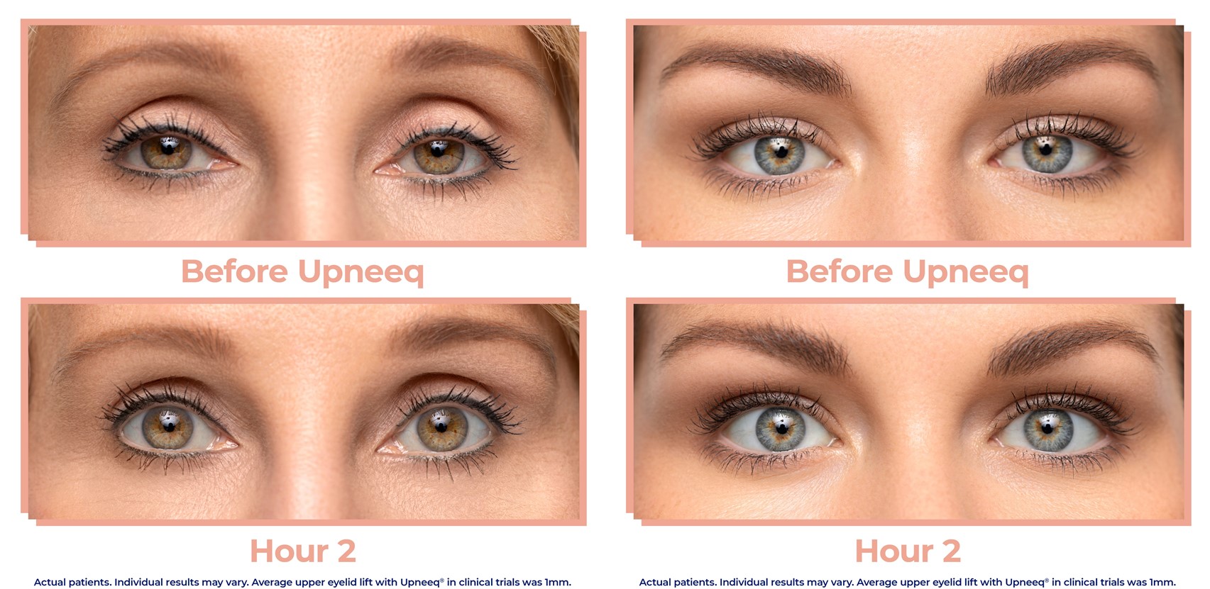 A person with Upneeq before and after treatment