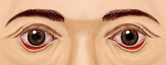 A close-up image showing a case of ectropion, where the lower eyelid is turned outward, exposing the inner surface of the eyelid and the eyeball.