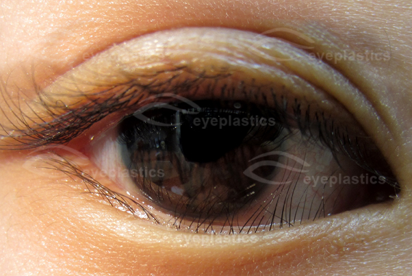 Image showing a case of Entropion, where the eyelid is inverted, causing irritation and discomfort. The image depicts the condition clearly, highlighting the affected area of the eye.