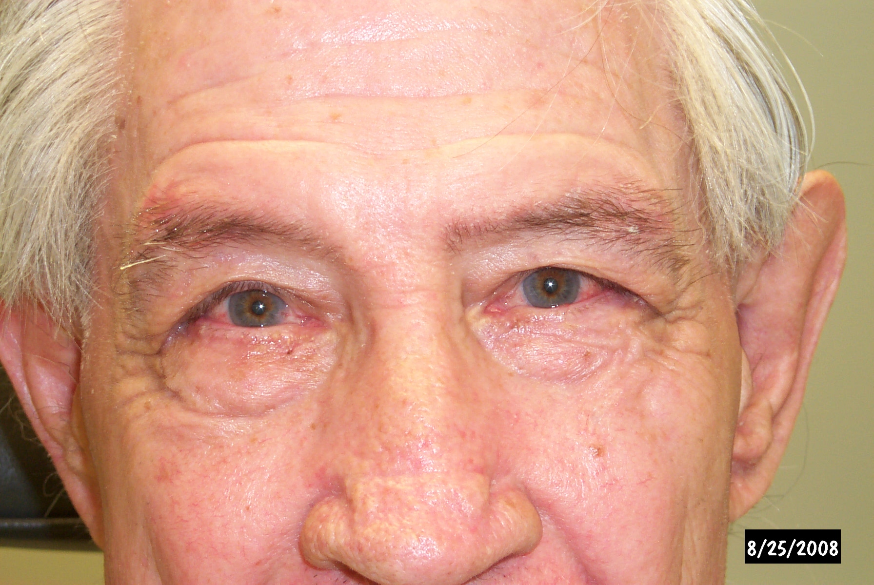 Image showing a close-up view of an eye with entropion, a condition where the eyelid is turned inward, causing the eyelashes to rub against the eye