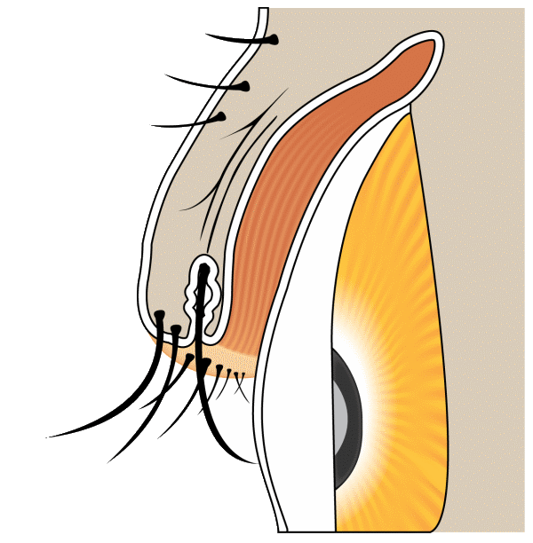 Illustration showing eyelashes growing from an abnormal location, known as distichiasis