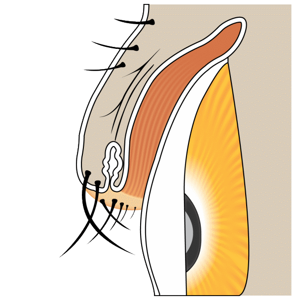 Illustration showing trichiasis, a condition where eyelashes grow inward towards the eye, causing irritation and potential damage.