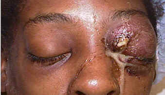 Clinical Photo of a patient with a subperiosteal abscess