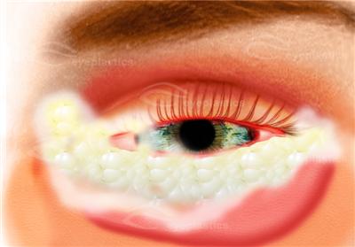 conjunctivitis