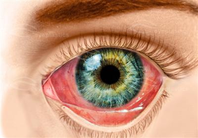 Conjunctivitis