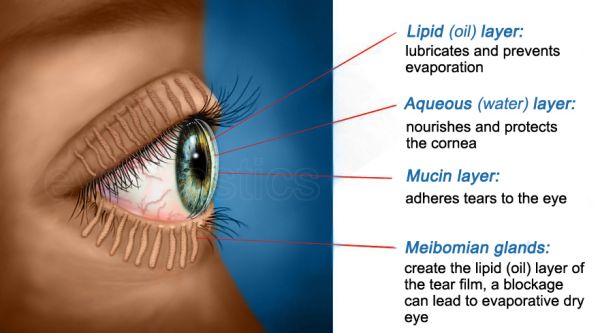 Image depicting a close-up view of an eye affected by blepharitis with text overlay indicating symptoms and treatment options
