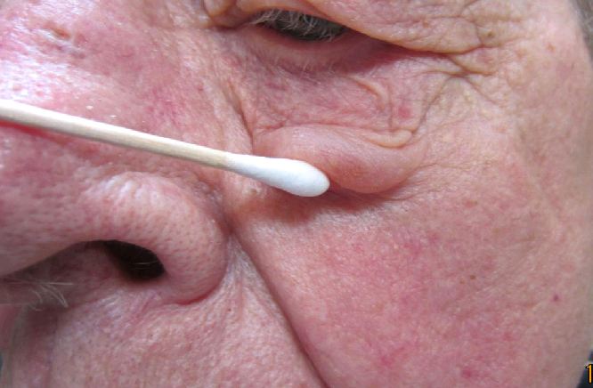 Image showing symptoms of rosacea including redness and inflammation on the skin.