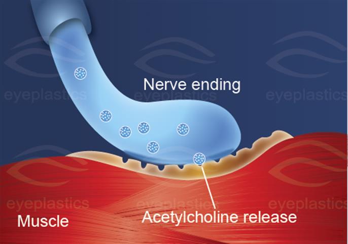 Illustration of a botulinum toxin molecule with accompanying text