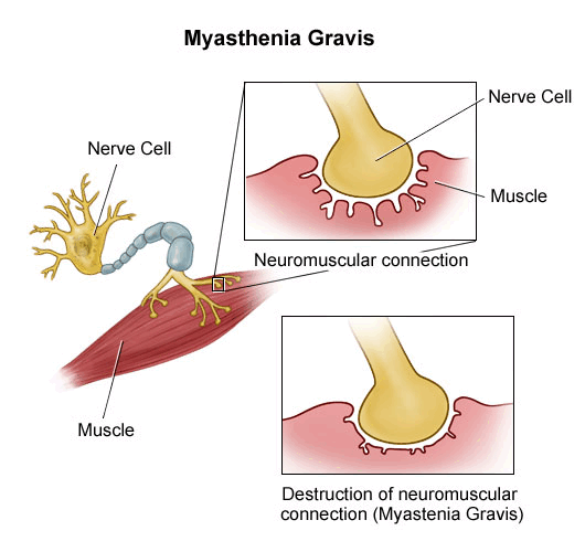 Image related to myasthenia gravis, including objects and embedded text describing the topic.